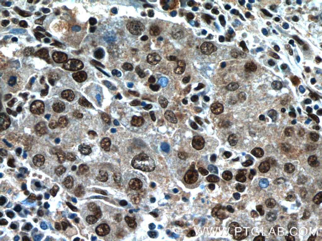 Immunohistochemistry (IHC) staining of human liver cancer tissue using NFKB2 Polyclonal antibody (10409-2-AP)