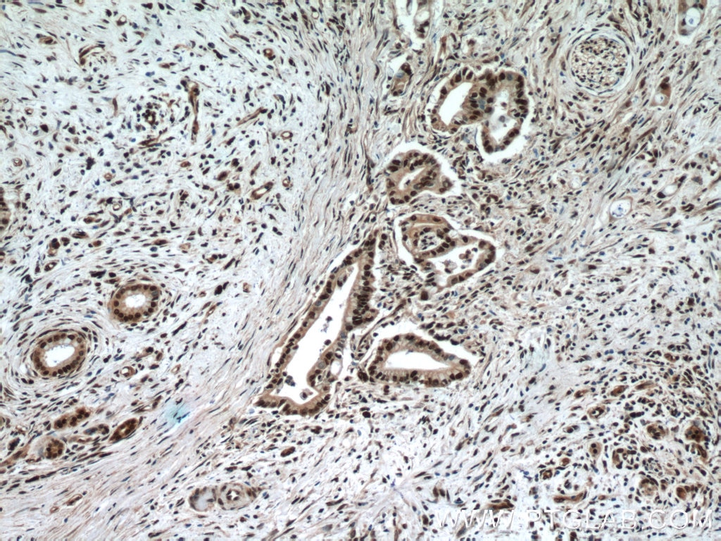 IHC staining of human pancreas cancer using 10409-2-AP