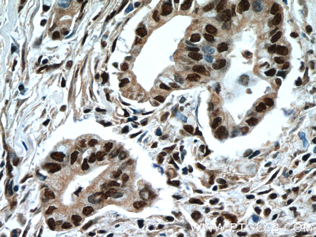 Immunohistochemistry (IHC) staining of human pancreas cancer tissue using NFKB2 Polyclonal antibody (10409-2-AP)