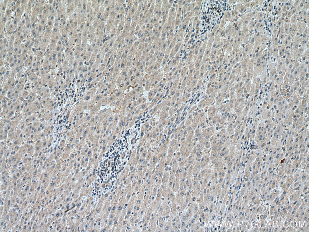 Immunohistochemistry (IHC) staining of human liver cancer tissue using NFKB2 Monoclonal antibody (66920-1-Ig)