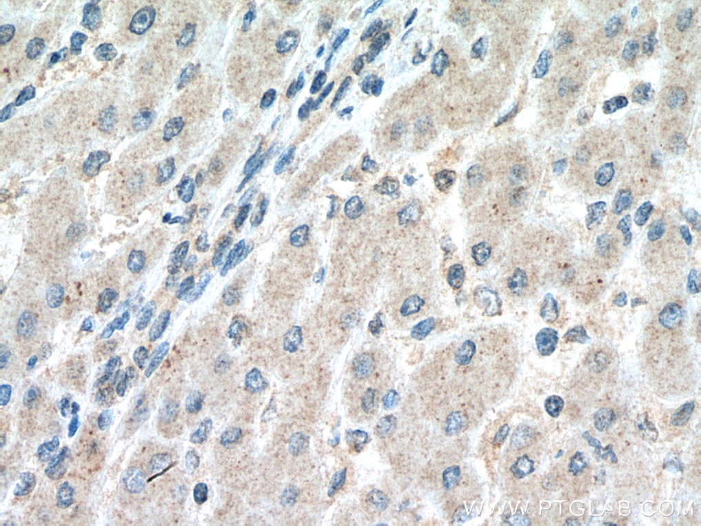 Immunohistochemistry (IHC) staining of human liver cancer tissue using NFKB2 Monoclonal antibody (66920-1-Ig)