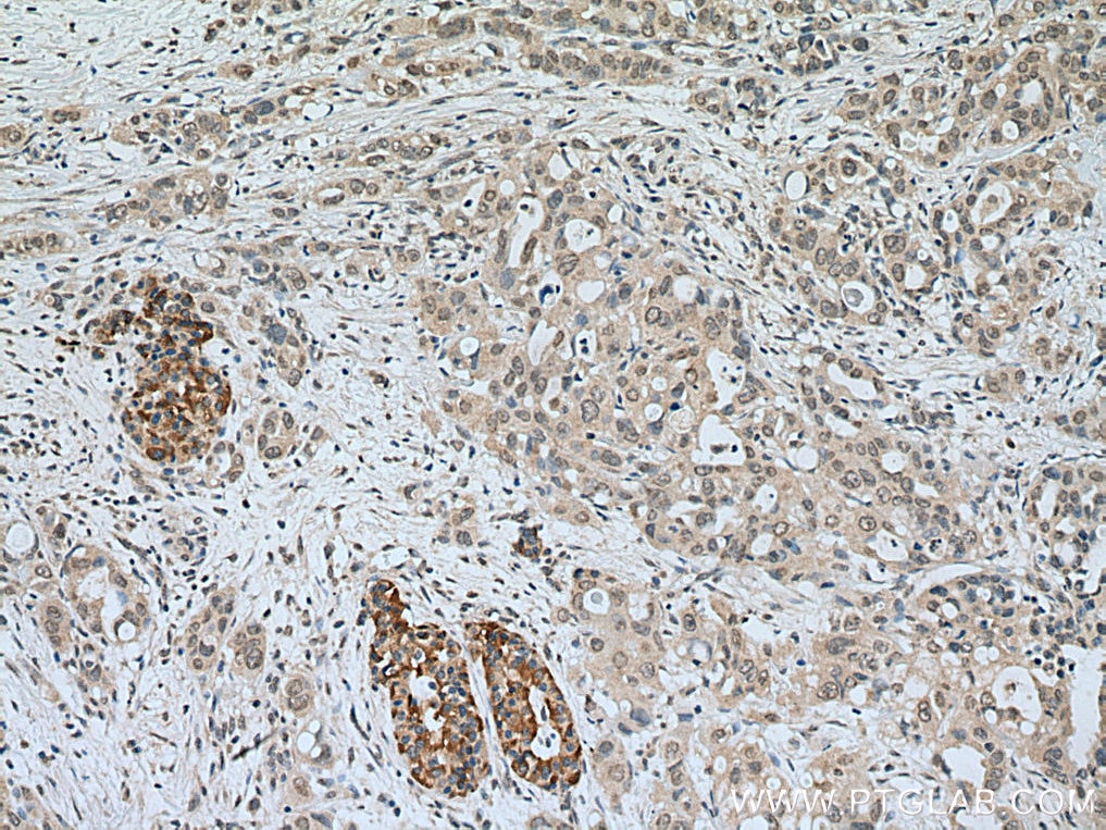 Immunohistochemistry (IHC) staining of human pancreas cancer tissue using NFKB2 Monoclonal antibody (66920-1-Ig)