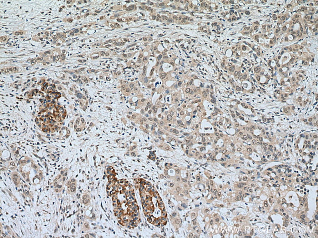 IHC staining of human pancreas cancer using 66920-1-Ig