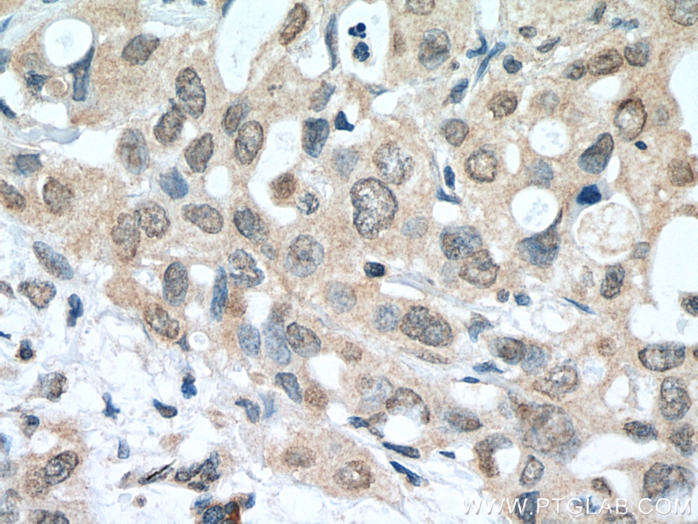 IHC staining of human pancreas cancer using 66920-1-Ig