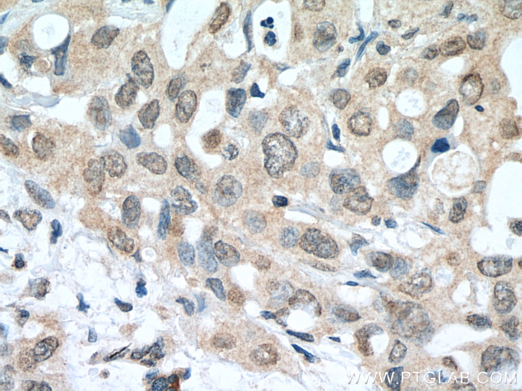 Immunohistochemistry (IHC) staining of human pancreas cancer tissue using NFKB2 Monoclonal antibody (66920-1-Ig)