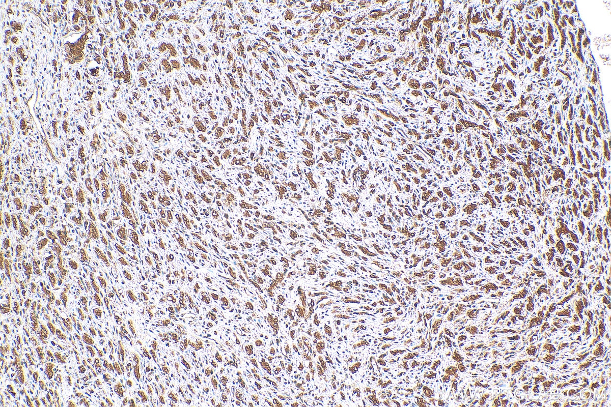 Immunohistochemistry (IHC) staining of human prostate cancer tissue using IkB Alpha Polyclonal antibody (10268-1-AP)