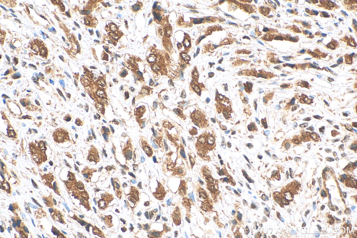 Immunohistochemistry (IHC) staining of human prostate cancer tissue using IkB Alpha Polyclonal antibody (10268-1-AP)