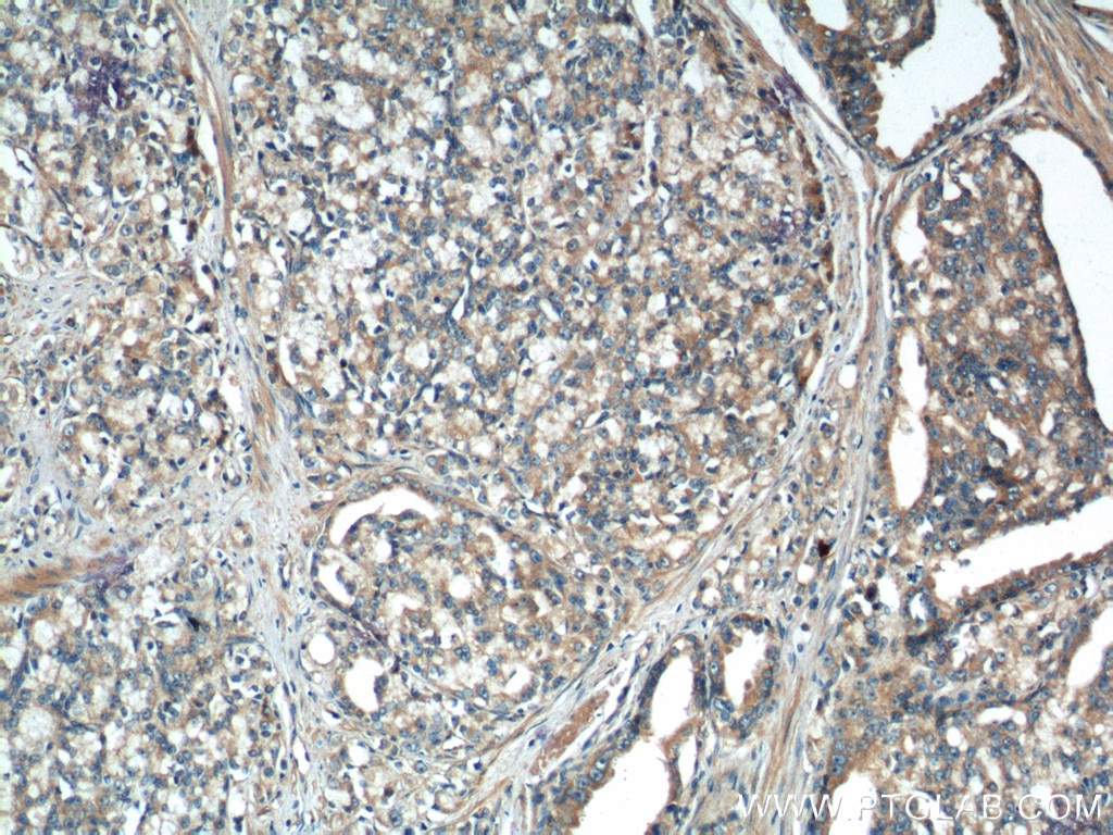 Immunohistochemistry (IHC) staining of human prostate cancer tissue using IkB Alpha Polyclonal antibody (10268-1-AP)