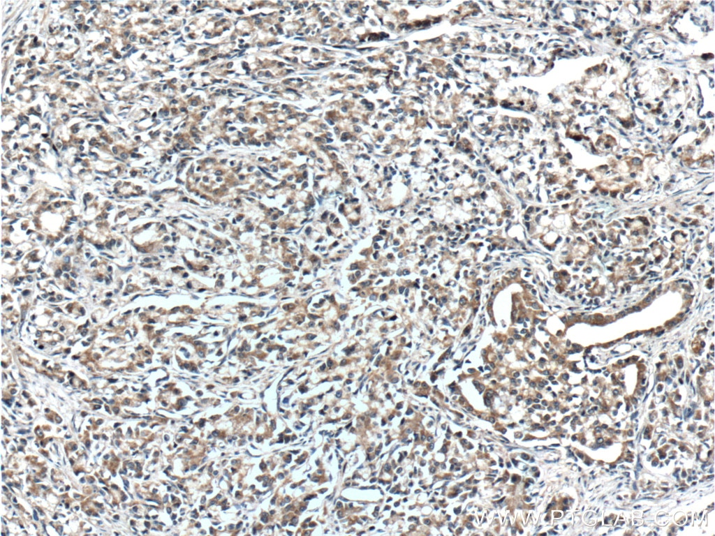 Immunohistochemistry (IHC) staining of human prostate cancer tissue using IkB Alpha Polyclonal antibody (18220-1-AP)