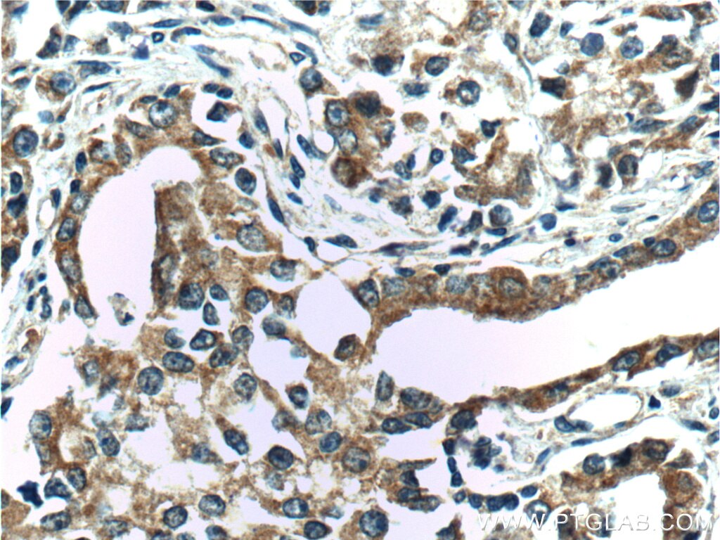 Immunohistochemistry (IHC) staining of human prostate cancer tissue using IkB Alpha Polyclonal antibody (18220-1-AP)