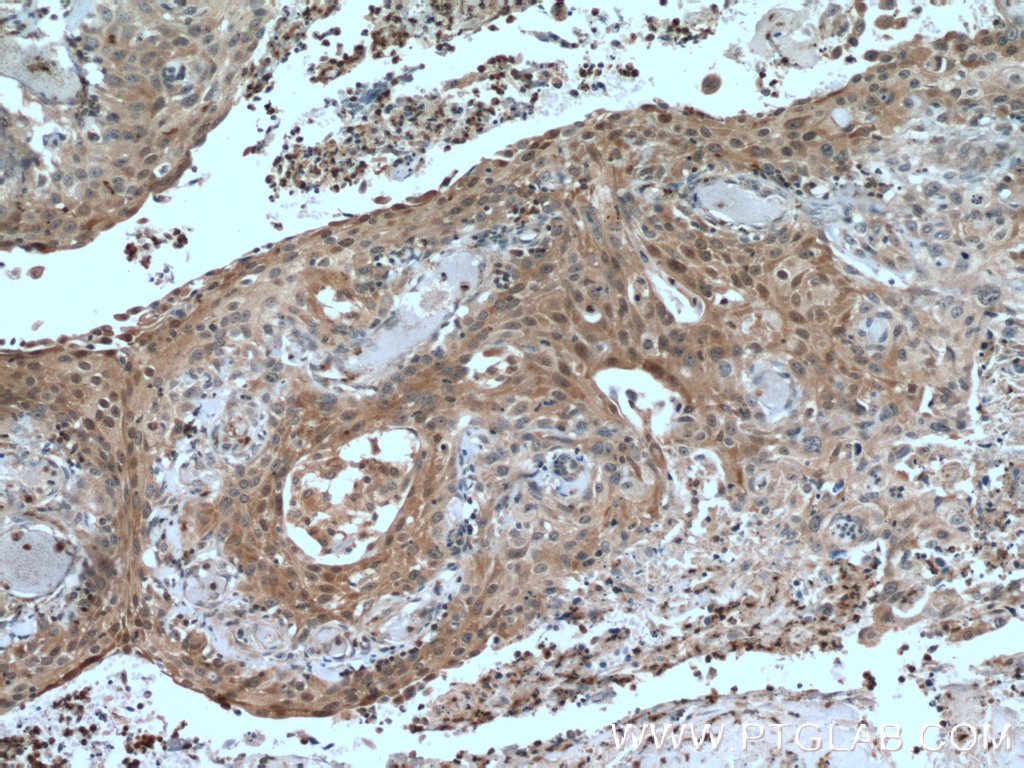 Immunohistochemistry (IHC) staining of human cervical cancer tissue using IkB Alpha Polyclonal antibody (51066-1-AP)