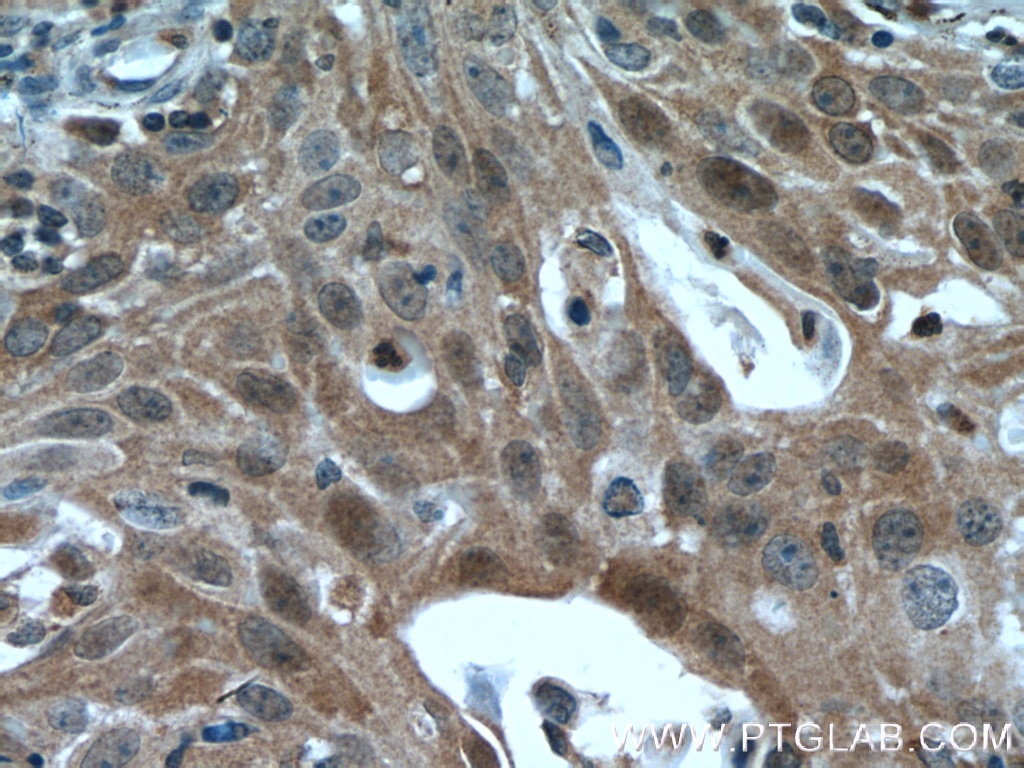Immunohistochemistry (IHC) staining of human cervical cancer tissue using IkB Alpha Polyclonal antibody (51066-1-AP)