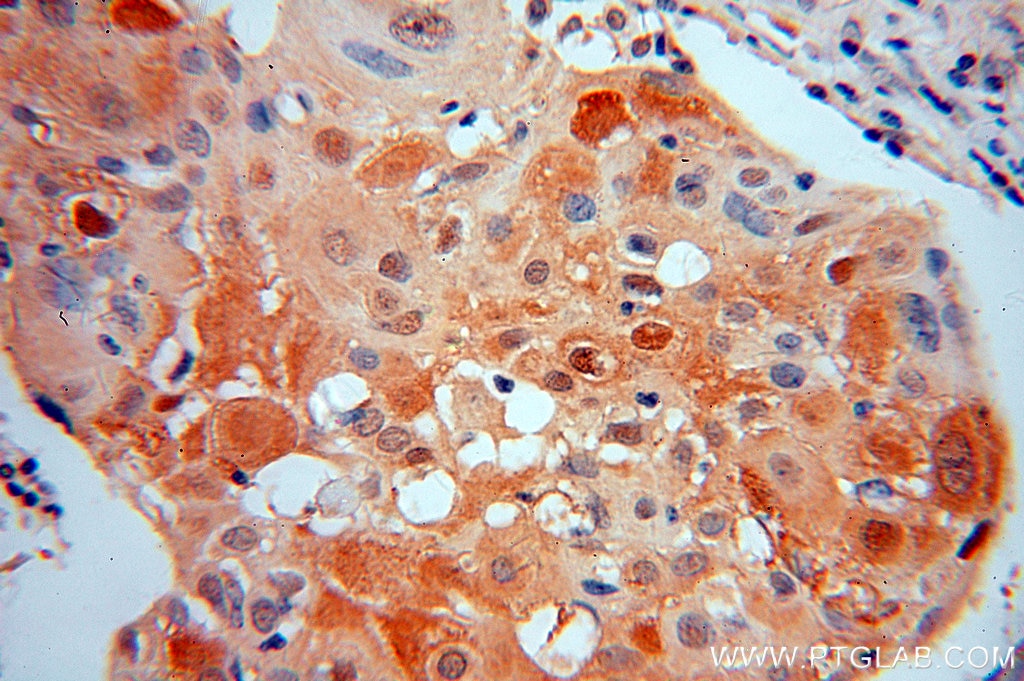Immunohistochemistry (IHC) staining of human cervical cancer tissue using IkB Alpha Polyclonal antibody (51066-1-AP)