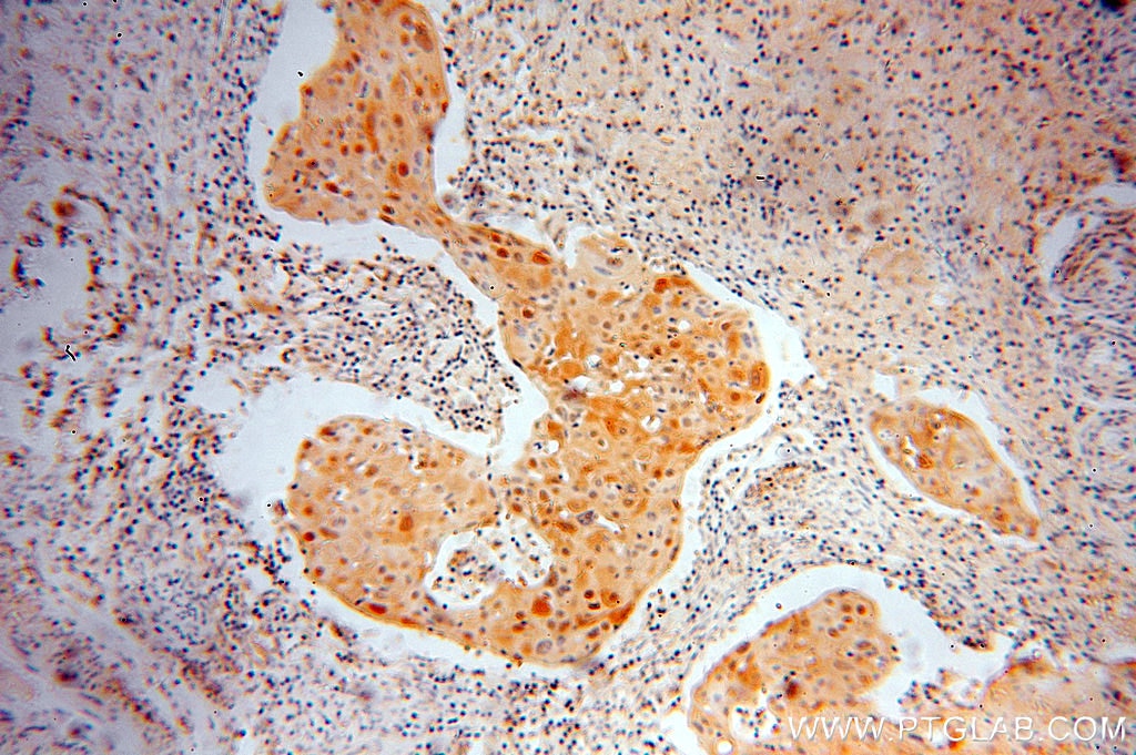 Immunohistochemistry (IHC) staining of human cervical cancer tissue using IkB Alpha Polyclonal antibody (51066-1-AP)