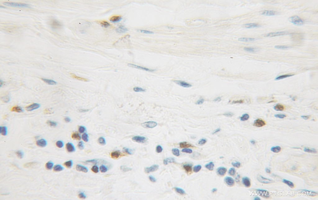 Immunohistochemistry (IHC) staining of human colon cancer tissue using IkB Beta Polyclonal antibody (12660-1-AP)