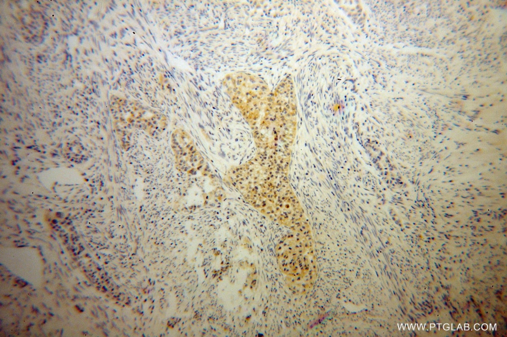 Immunohistochemistry (IHC) staining of human endometrial cancer tissue using IkB Beta Polyclonal antibody (12660-1-AP)