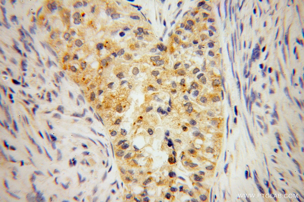 Immunohistochemistry (IHC) staining of human endometrial cancer tissue using IkB Beta Polyclonal antibody (12660-1-AP)