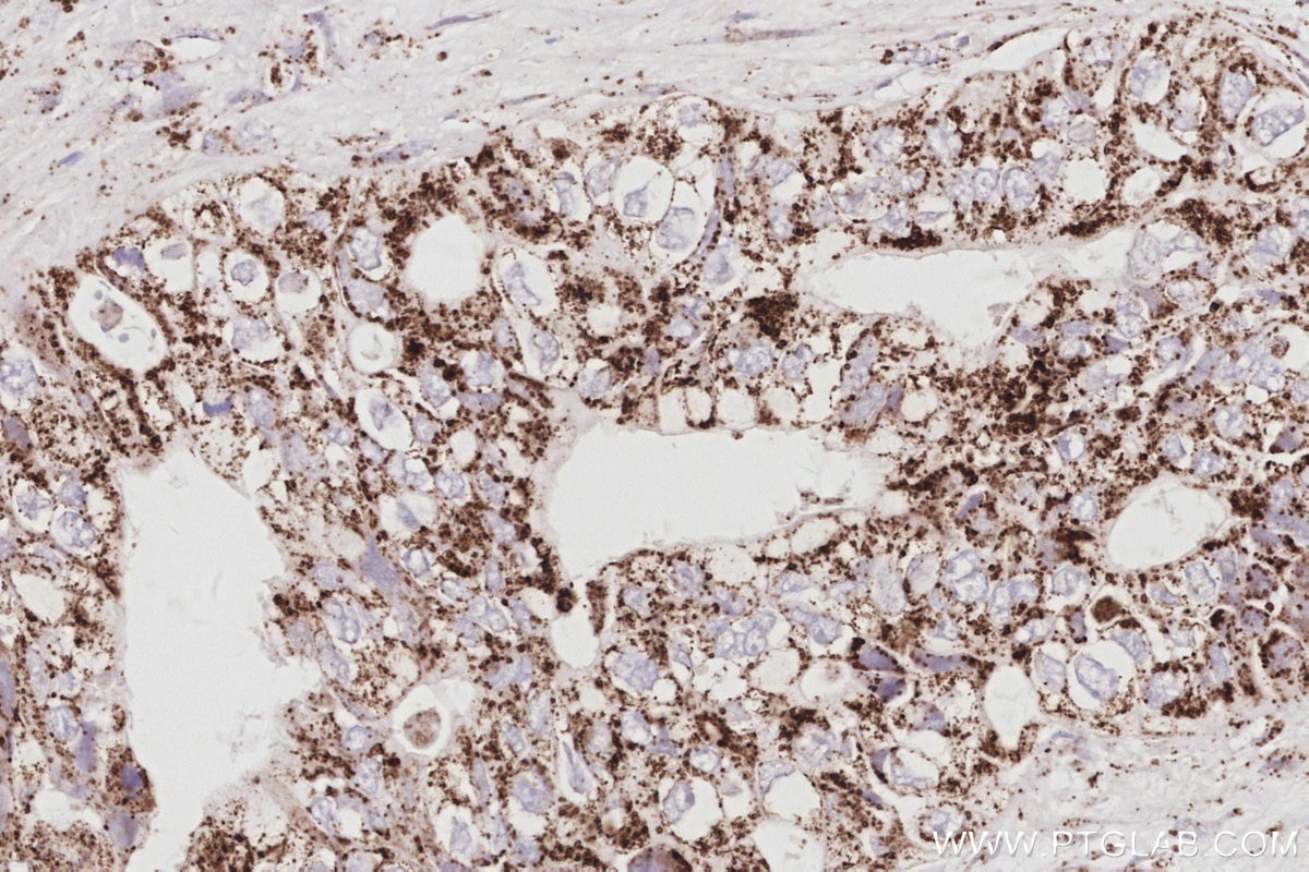 Immunohistochemistry (IHC) staining of human pancreas cancer tissue using NFS1 Polyclonal antibody (15370-1-AP)