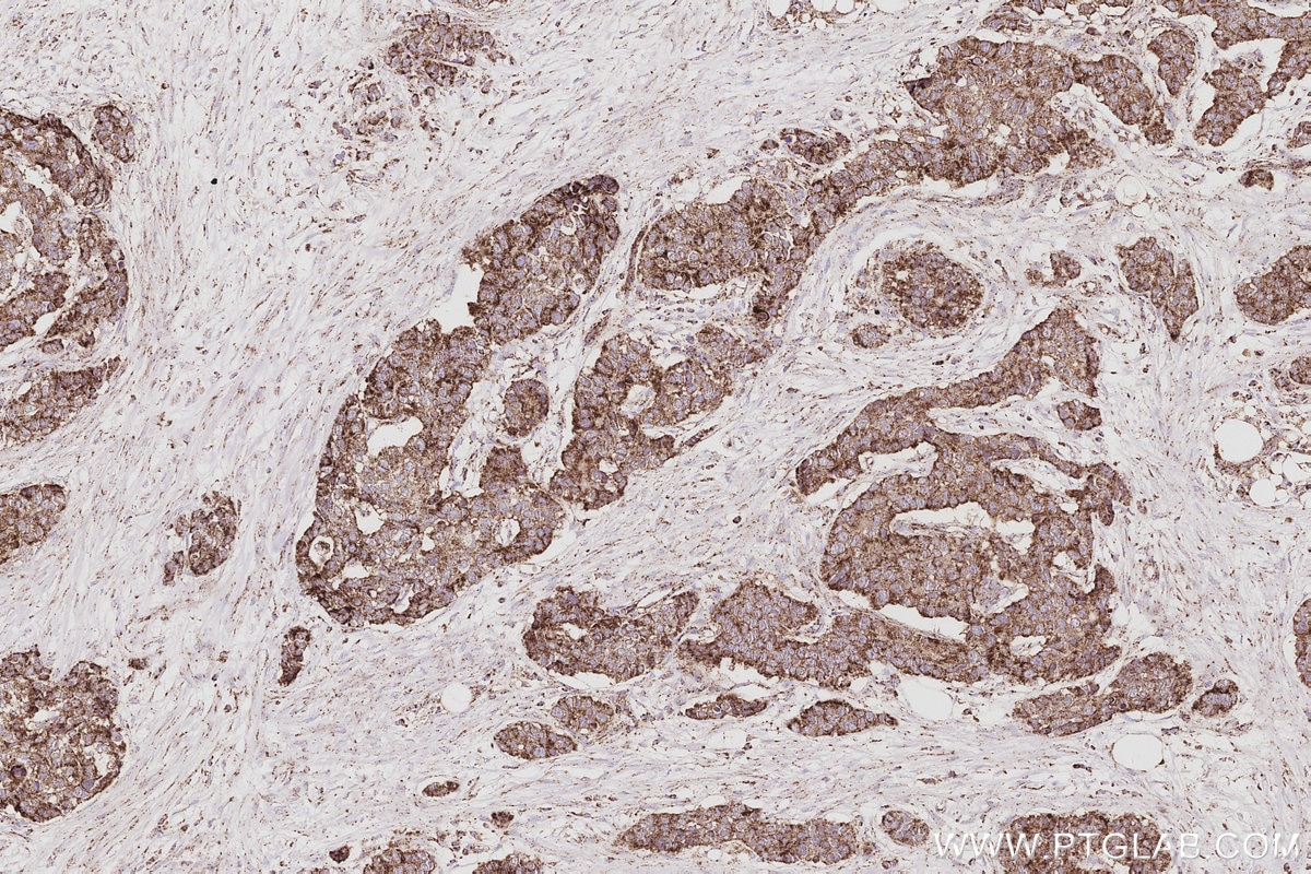 Immunohistochemistry (IHC) staining of human stomach cancer tissue using NFS1 Polyclonal antibody (15370-1-AP)