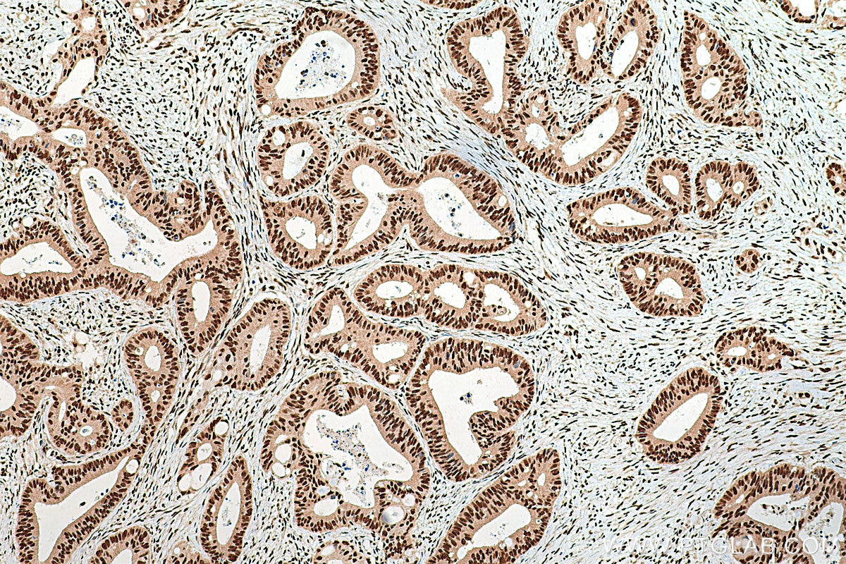 Immunohistochemistry (IHC) staining of human colon cancer tissue using NFYA Polyclonal antibody (12981-1-AP)