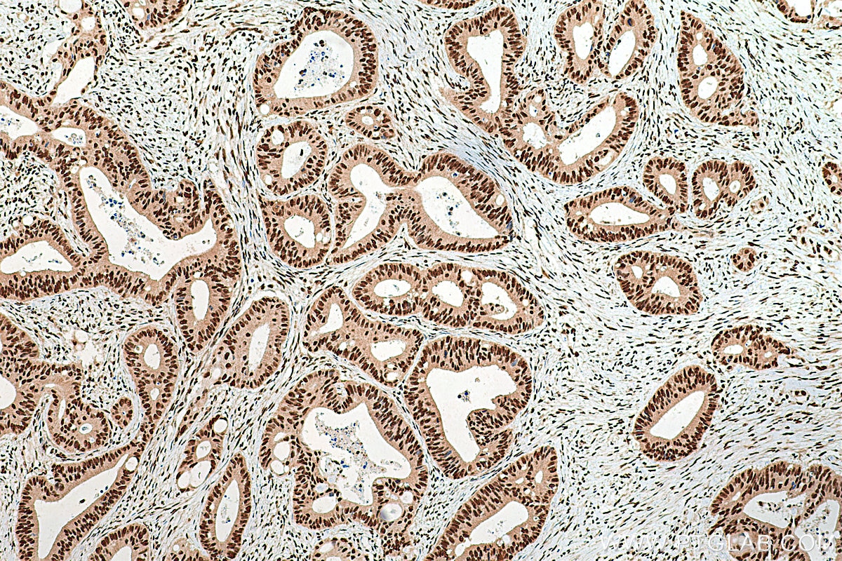 IHC staining of human colon cancer using 12981-1-AP