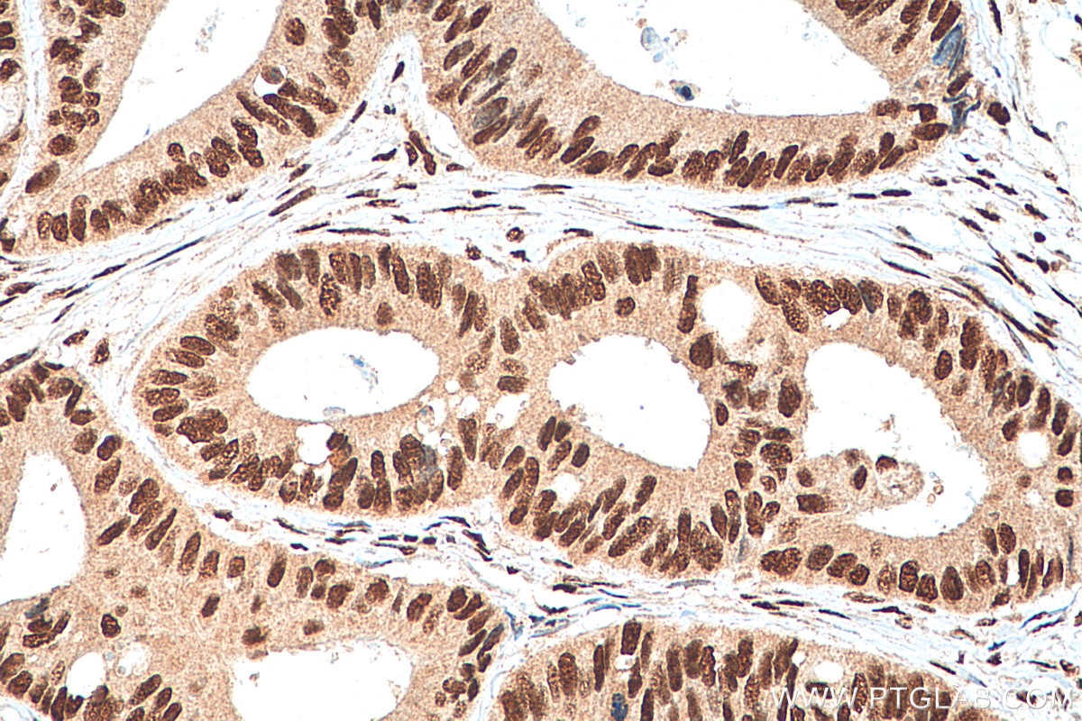 Immunohistochemistry (IHC) staining of human colon cancer tissue using NFYA Polyclonal antibody (12981-1-AP)