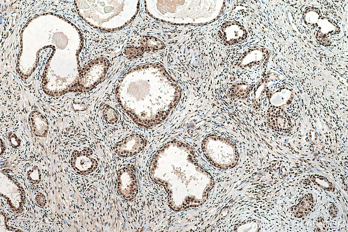 Immunohistochemistry (IHC) staining of human prostate cancer tissue using NFYA Polyclonal antibody (12981-1-AP)