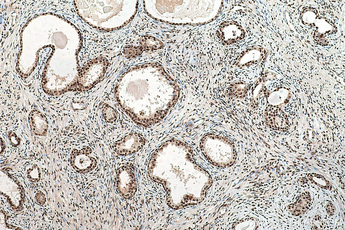 IHC staining of human prostate cancer using 12981-1-AP