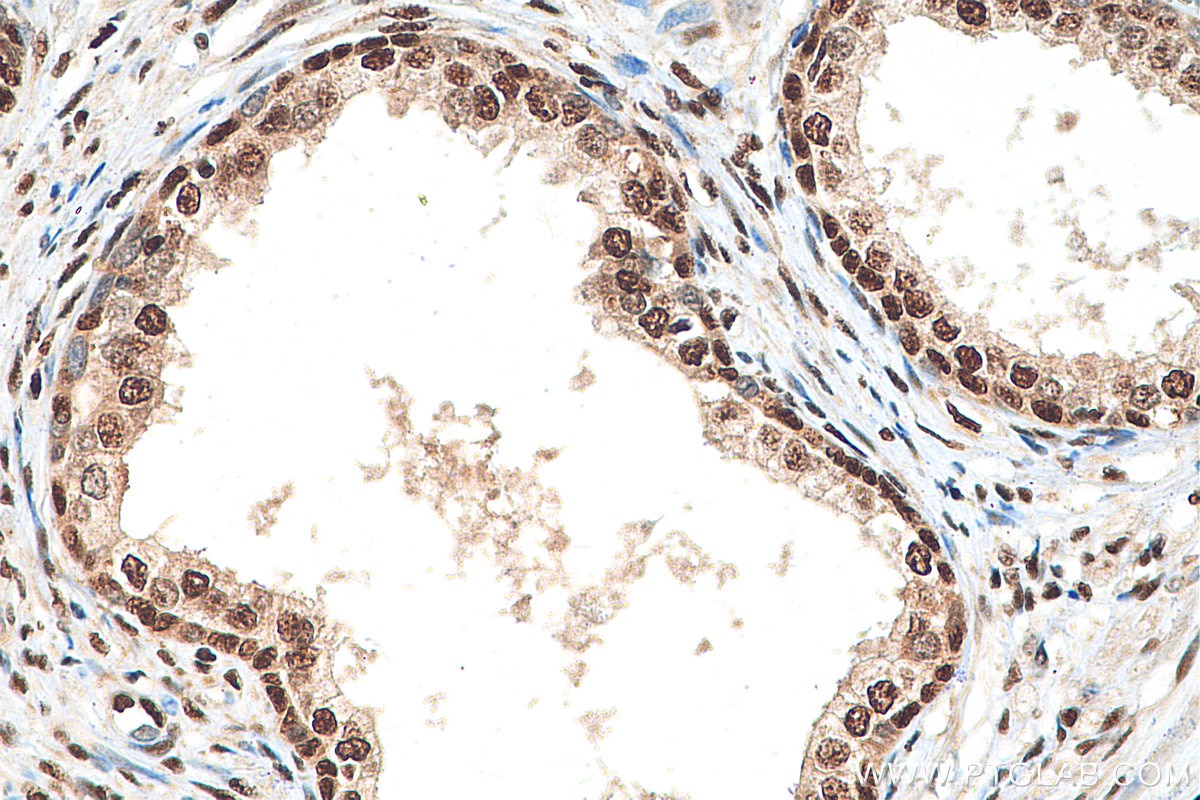 Immunohistochemistry (IHC) staining of human prostate cancer tissue using NFYA Polyclonal antibody (12981-1-AP)