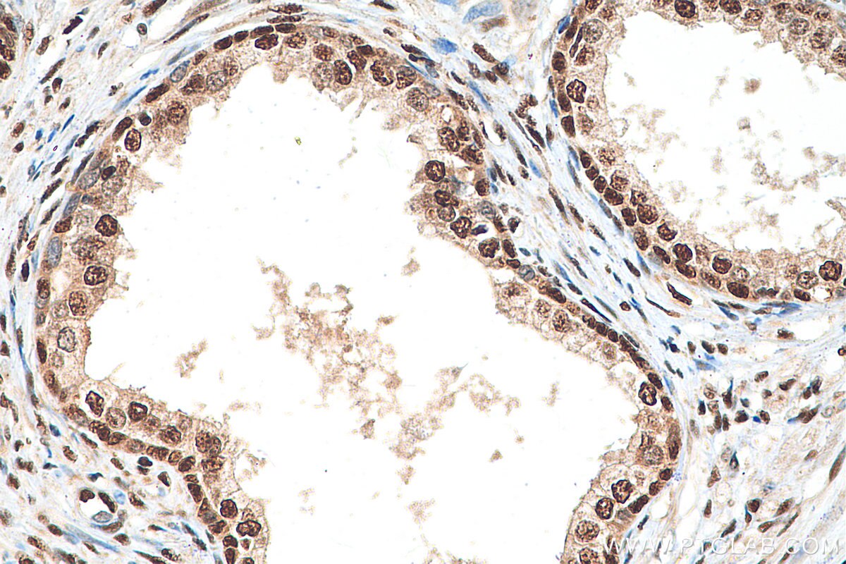 IHC staining of human prostate cancer using 12981-1-AP