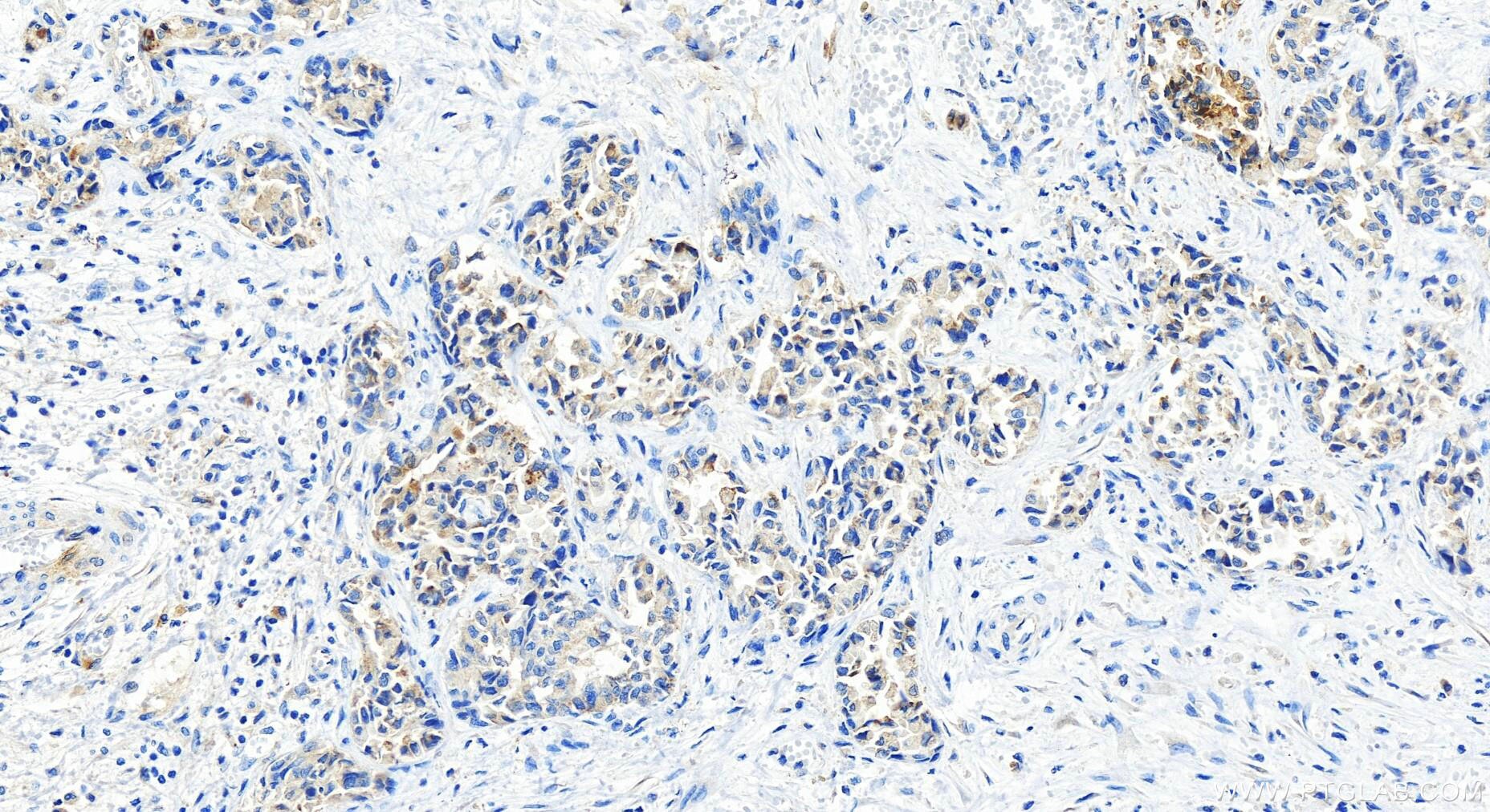 Immunohistochemistry (IHC) staining of human intrahepatic cholangiocarcinoma tissue using Lipocalin-2/NGAL Recombinant antibody (82841-1-RR)