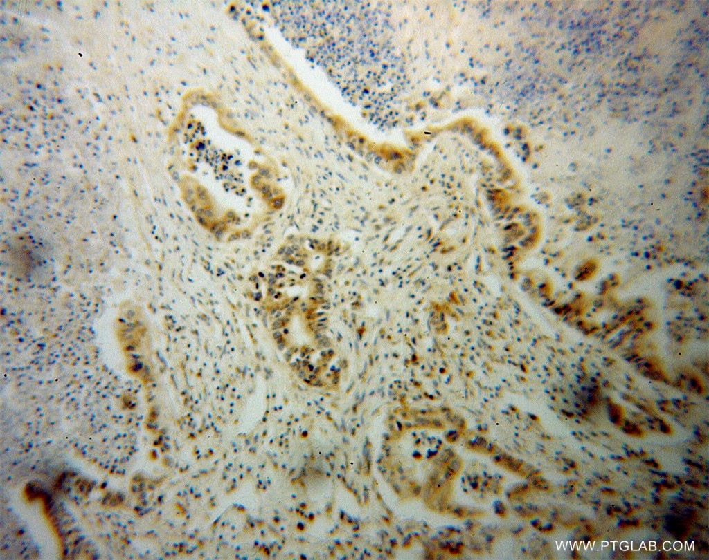 Immunohistochemistry (IHC) staining of human pancreas cancer tissue using NGB Polyclonal antibody (13499-1-AP)
