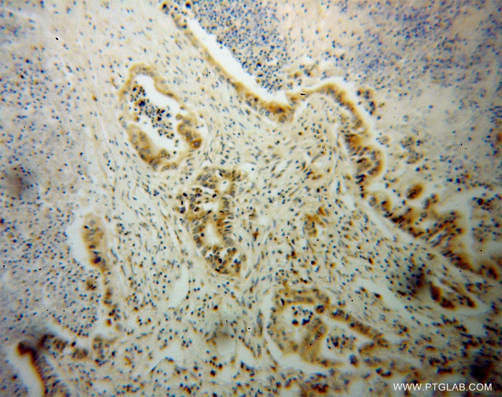 IHC staining of human pancreas cancer using 13499-1-AP