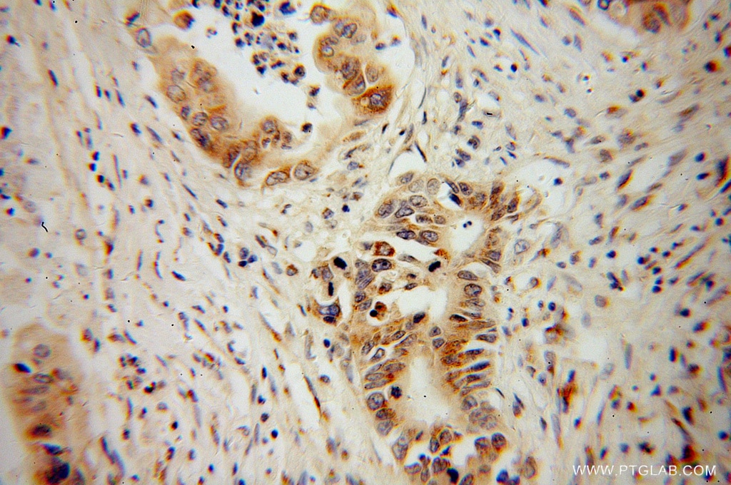 Immunohistochemistry (IHC) staining of human pancreas cancer tissue using NGB Polyclonal antibody (13499-1-AP)