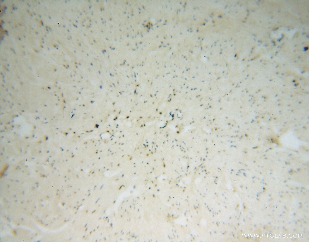 Immunohistochemistry (IHC) staining of human prostate cancer tissue using NHP2 Polyclonal antibody (15128-1-AP)