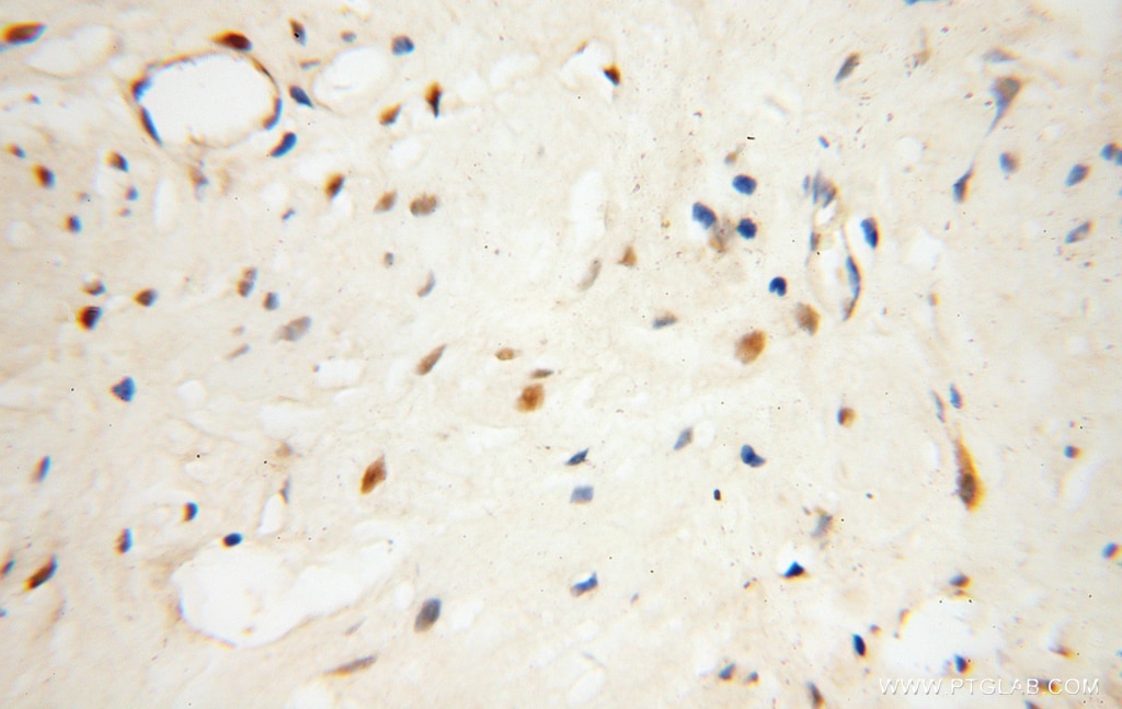 IHC staining of human prostate cancer using 15128-1-AP