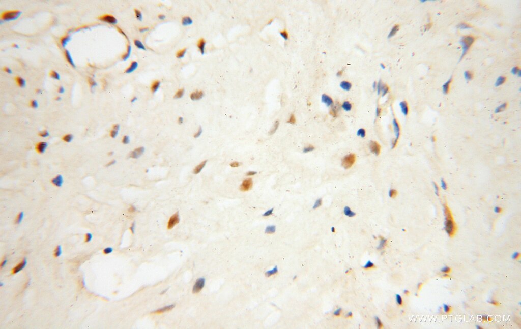 Immunohistochemistry (IHC) staining of human prostate cancer tissue using NHP2 Polyclonal antibody (15128-1-AP)