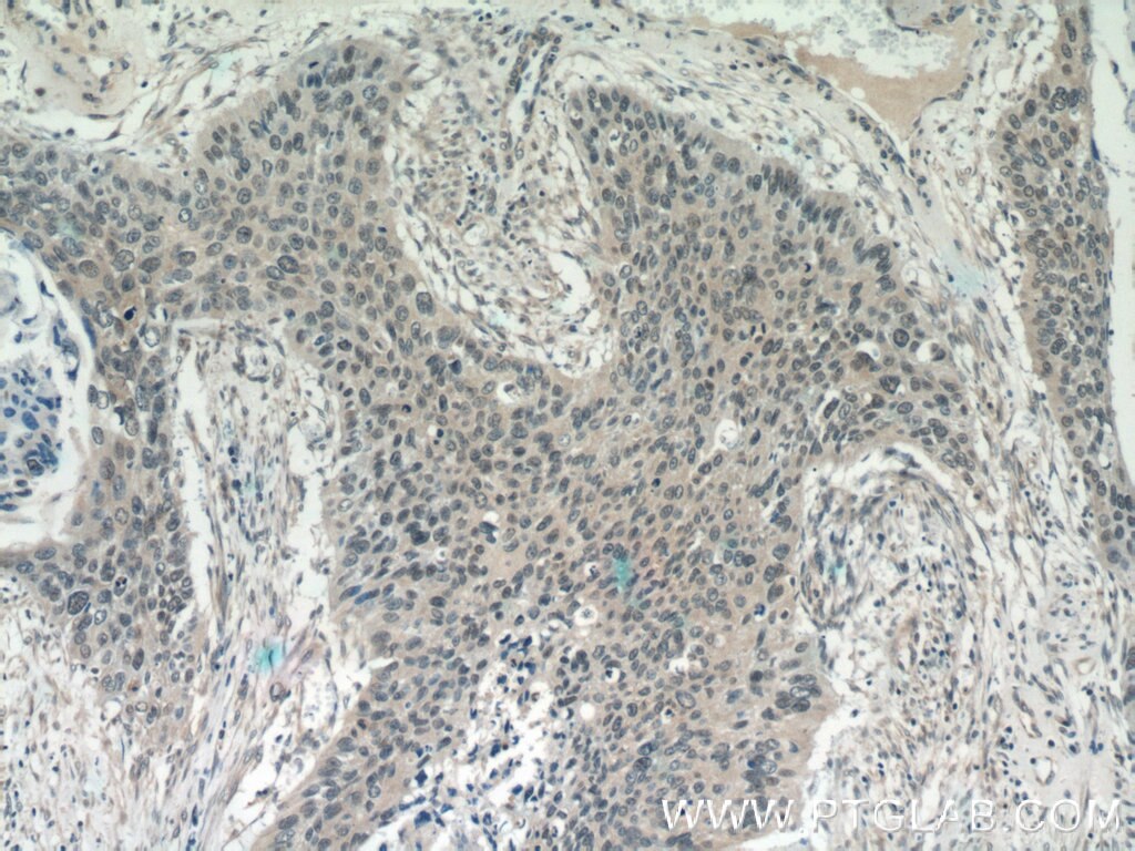 Immunohistochemistry (IHC) staining of human cervical cancer tissue using NHP2L1 Polyclonal antibody (15802-1-AP)
