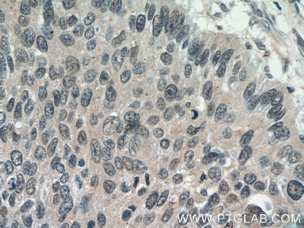 Immunohistochemistry (IHC) staining of human cervical cancer tissue using NHP2L1 Polyclonal antibody (15802-1-AP)
