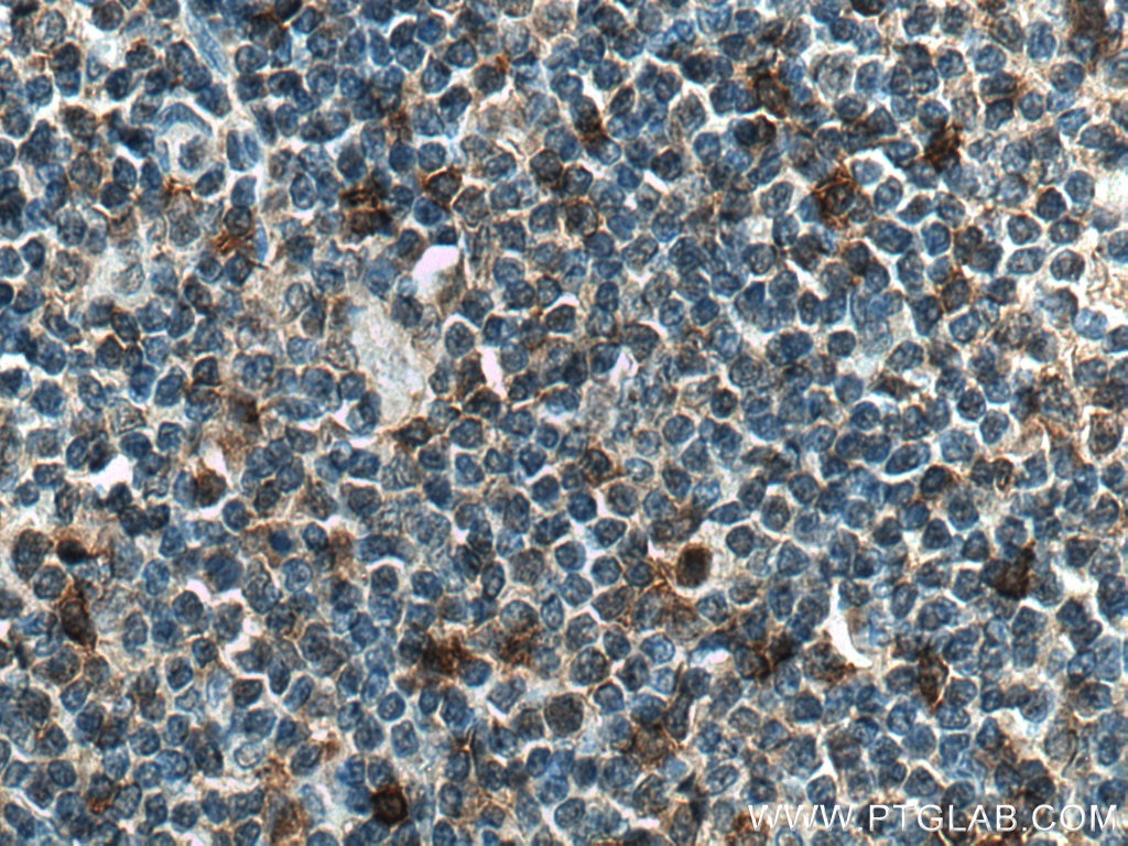 Immunohistochemistry (IHC) staining of human tonsillitis tissue using NINJ2 Polyclonal antibody (14085-1-AP)
