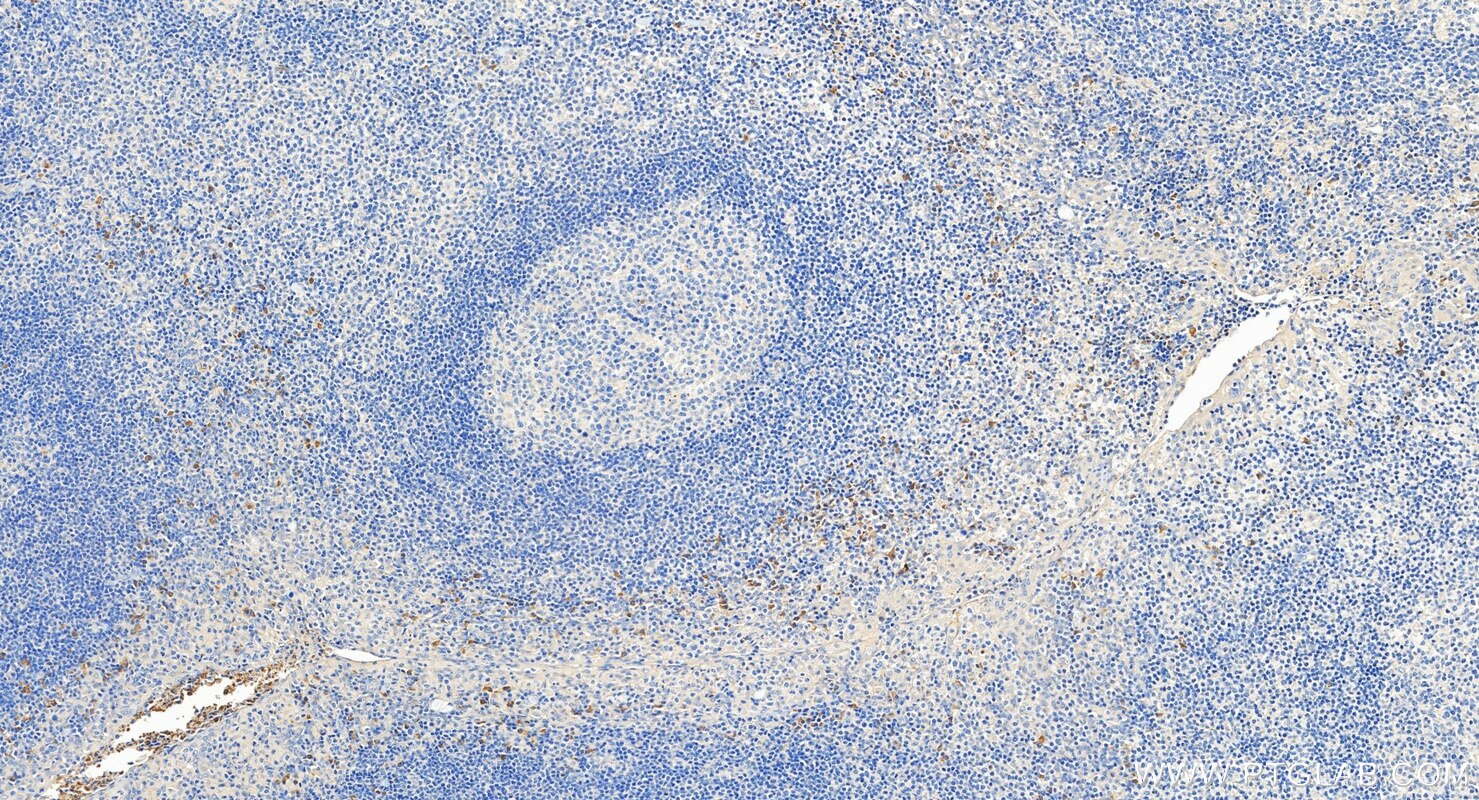 Immunohistochemistry (IHC) staining of human tonsillitis tissue using NINJ2 Polyclonal antibody (14085-1-AP)