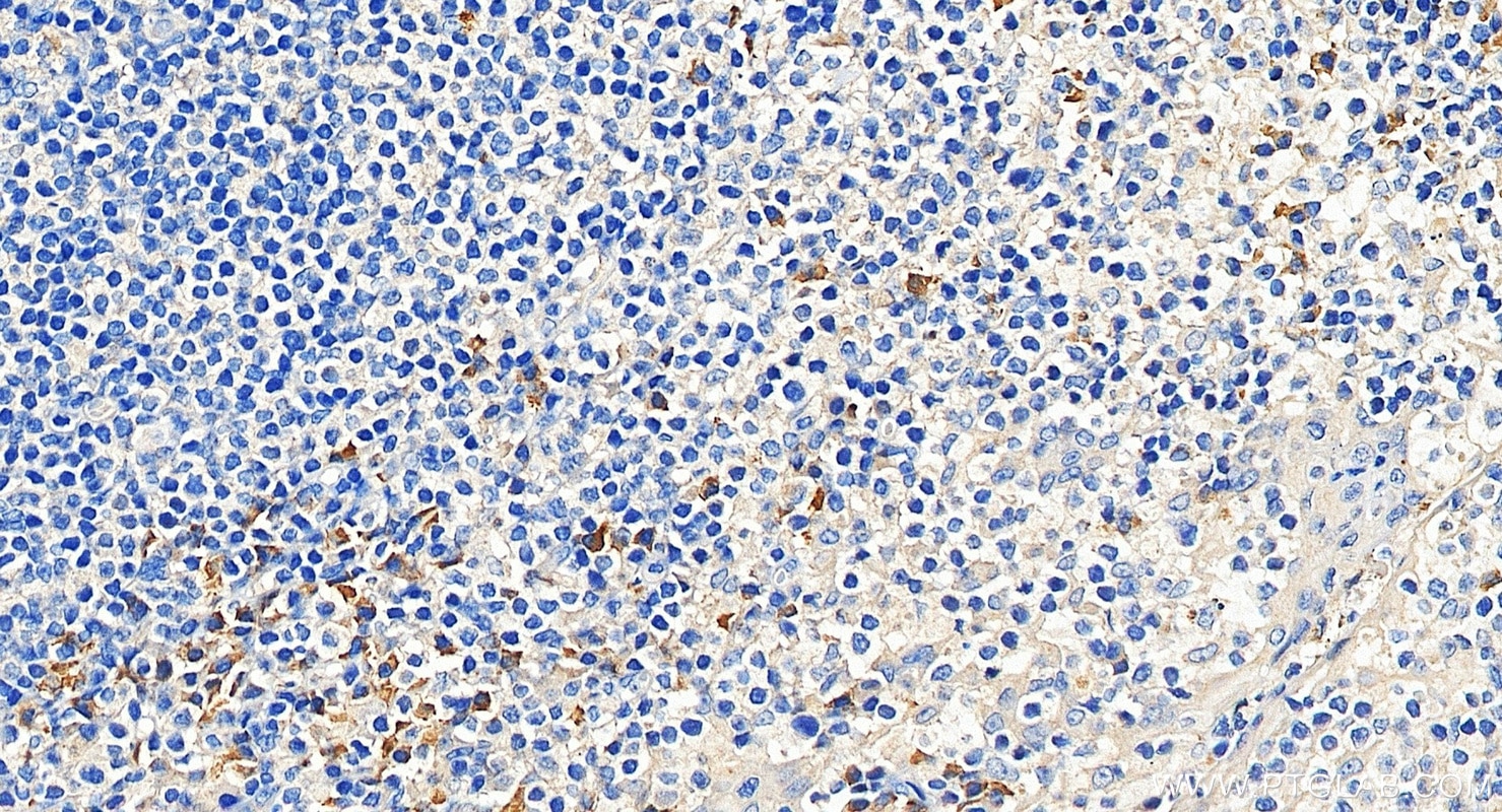 Immunohistochemistry (IHC) staining of human tonsillitis tissue using NINJ2 Polyclonal antibody (14085-1-AP)