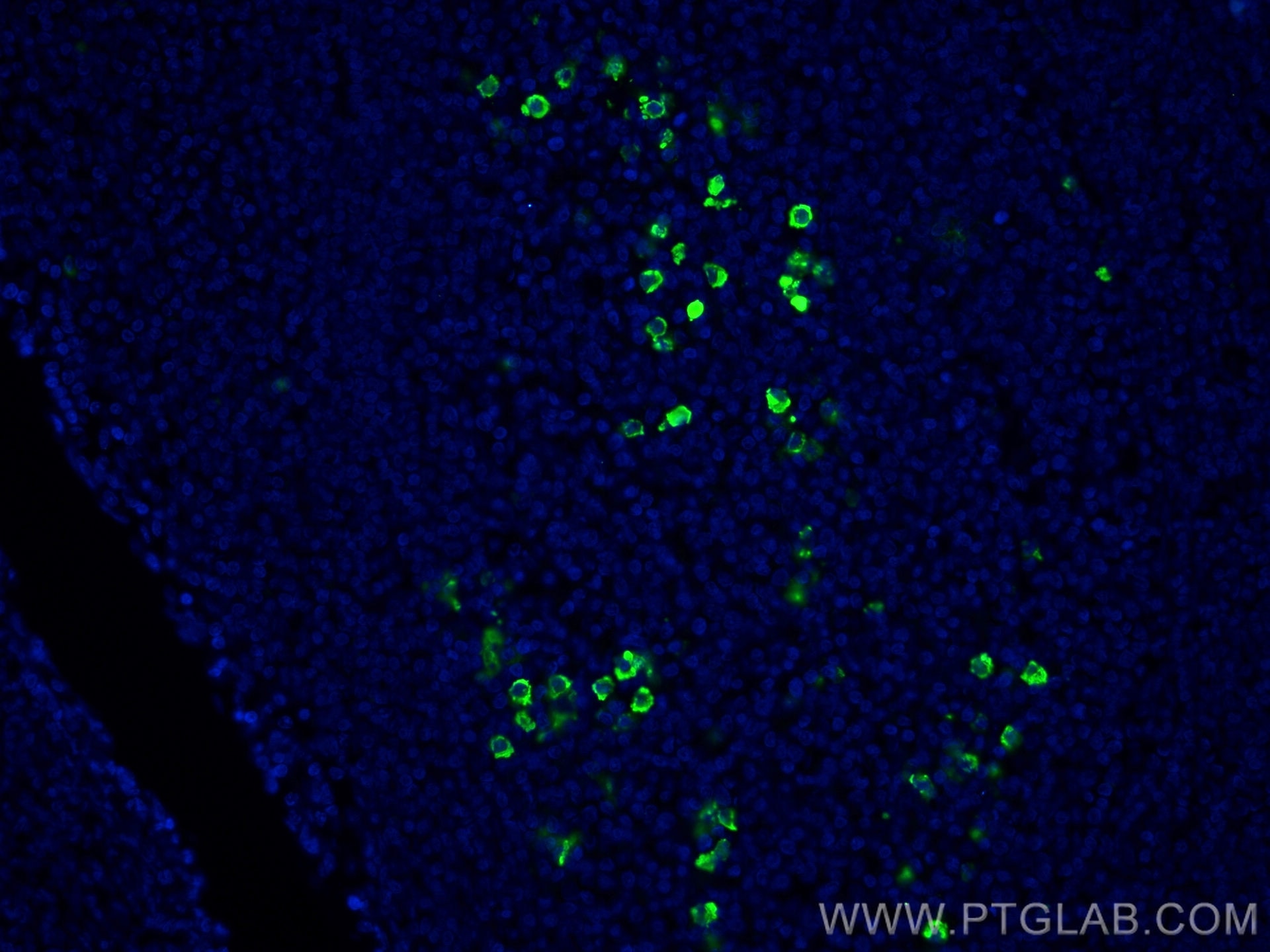 IF Staining of human tonsillitis using 66202-1-Ig