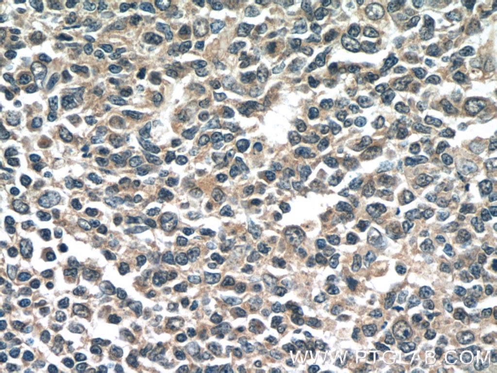 Immunohistochemistry (IHC) staining of human tonsillitis tissue using NINJ2 Monoclonal antibody (66202-1-Ig)