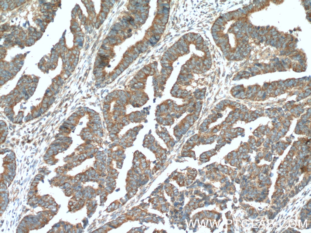 Immunohistochemistry (IHC) staining of human colon cancer tissue using NIPSNAP3A Polyclonal antibody (10751-1-AP)