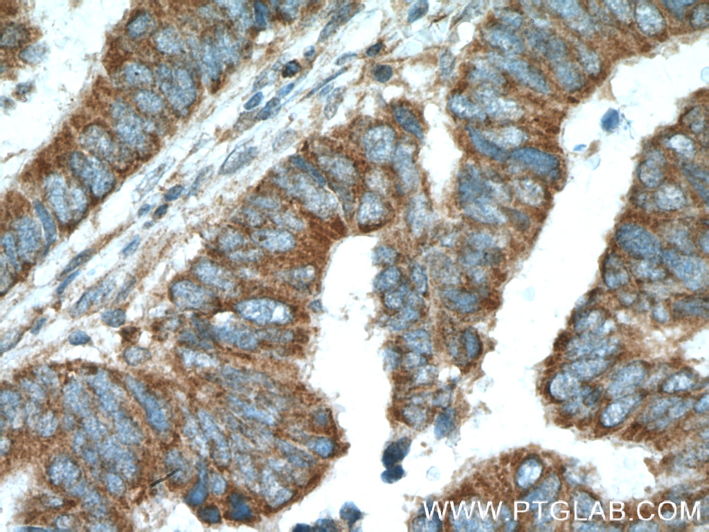 Immunohistochemistry (IHC) staining of human colon cancer tissue using NIPSNAP3A Polyclonal antibody (10751-1-AP)