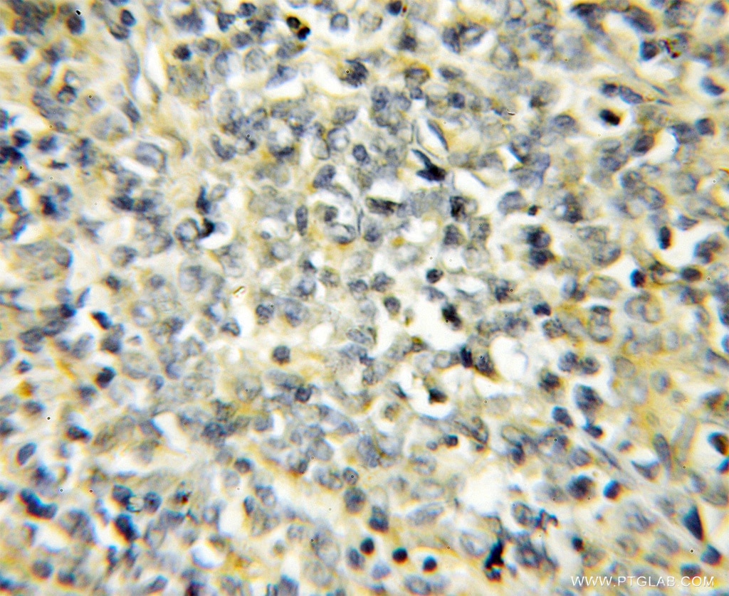 Immunohistochemistry (IHC) staining of human lymphoma tissue using NIPSNAP3B Polyclonal antibody (11789-1-AP)