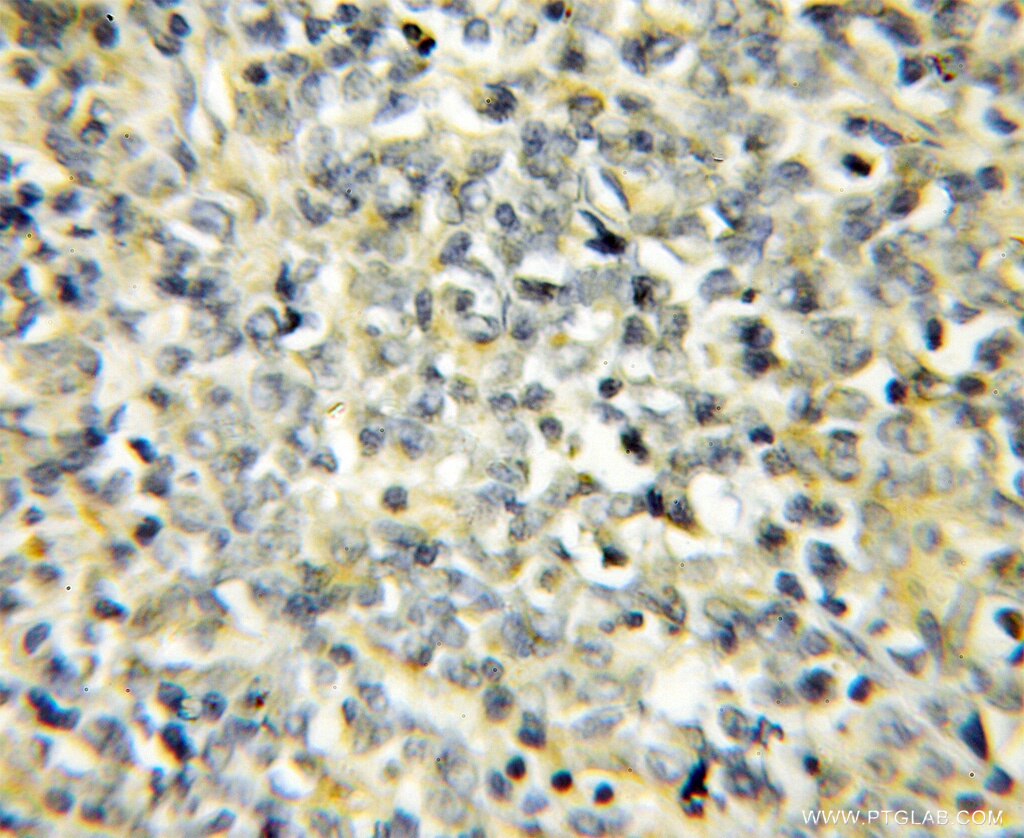 Immunohistochemistry (IHC) staining of human lymphoma tissue using NIPSNAP3B Polyclonal antibody (11789-1-AP)