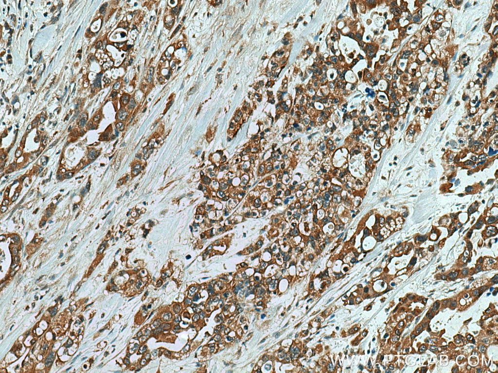 IHC staining of human pancreas cancer using 14380-1-AP