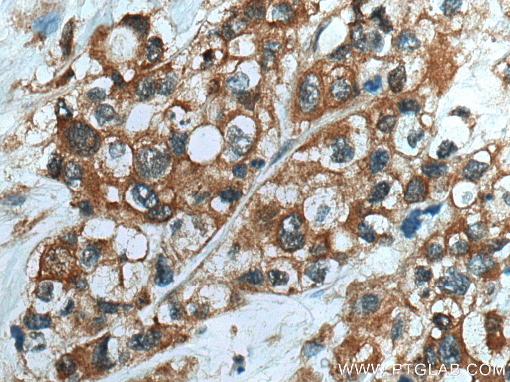 Immunohistochemistry (IHC) staining of human pancreas cancer tissue using NIT1 Polyclonal antibody (14380-1-AP)